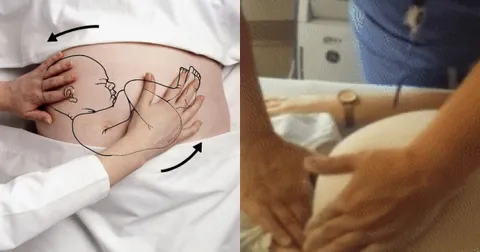 Kỳ diệu bác sĩ xoay chuyển thai nhi 40 tuần ngôi ngược bằng tay